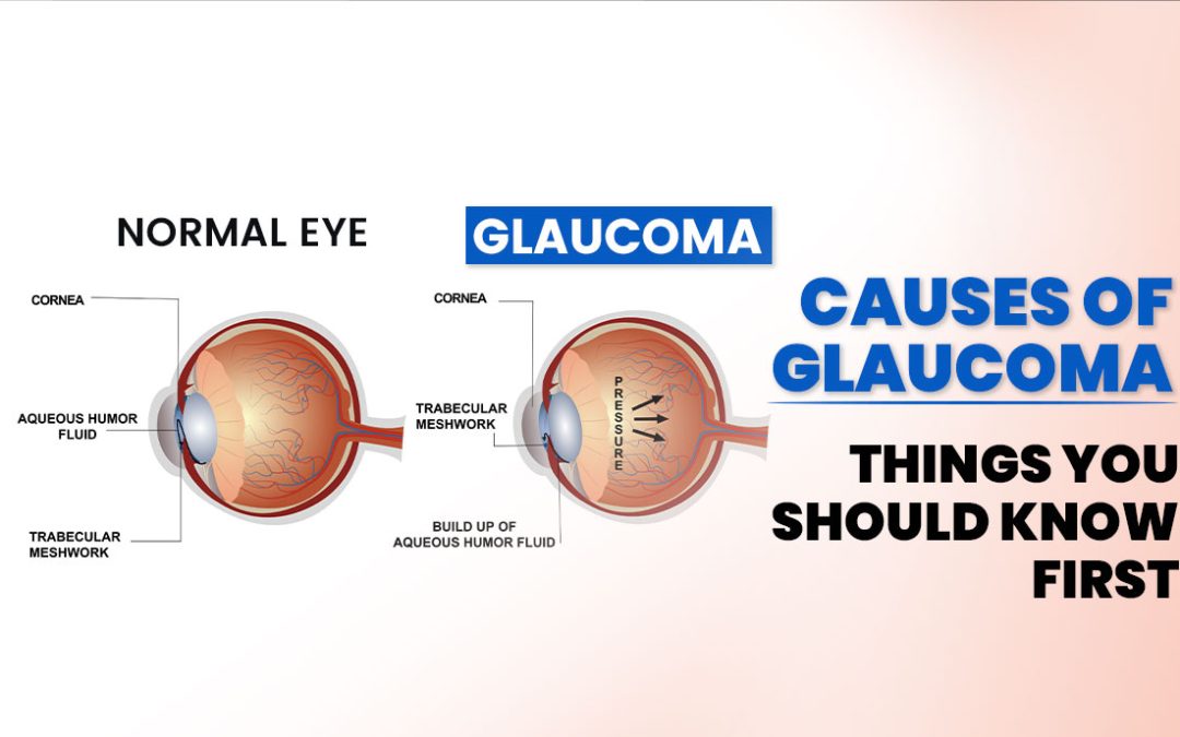 Causes Of Glaucoma: Things You Should Know First