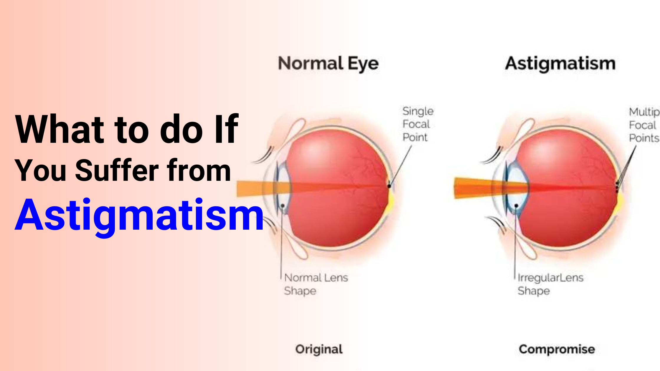 What to do If You Suffer from Astigmatism